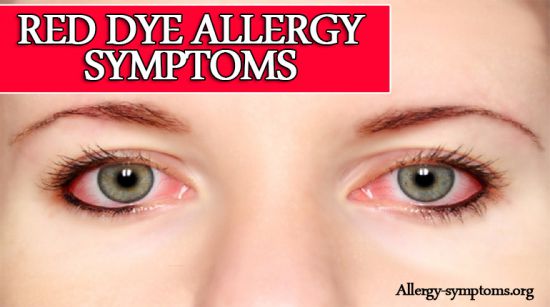 Red Dye Allergy Symptoms, Causes and Treatment - Allergy Symptoms