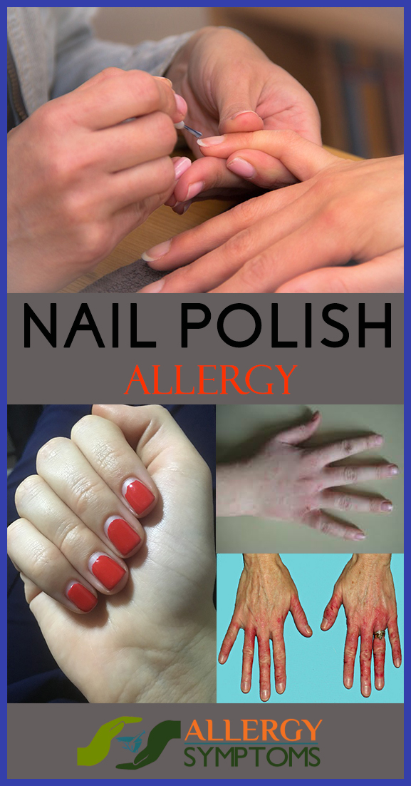 nail polish allergy