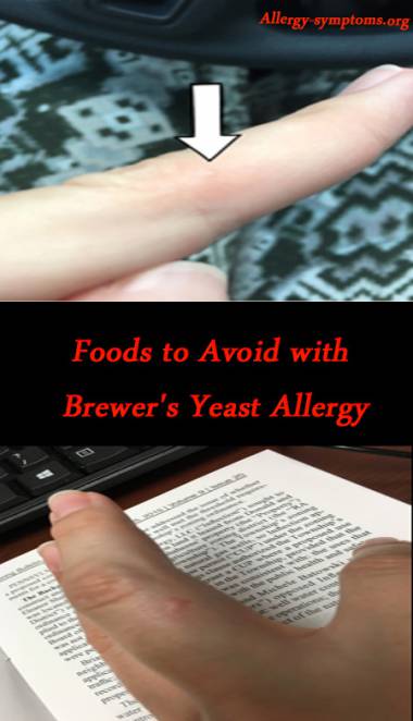 foods-to-avoid-with-brewers-yeast-allergy