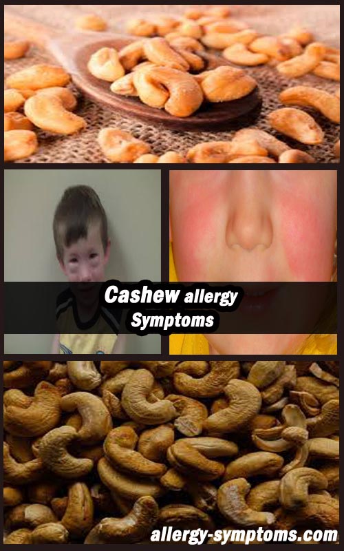 cashew allergy