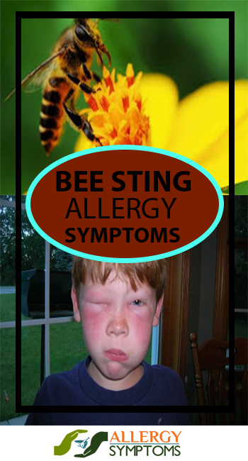 BEE STING ALLERGY SYMPTOMS