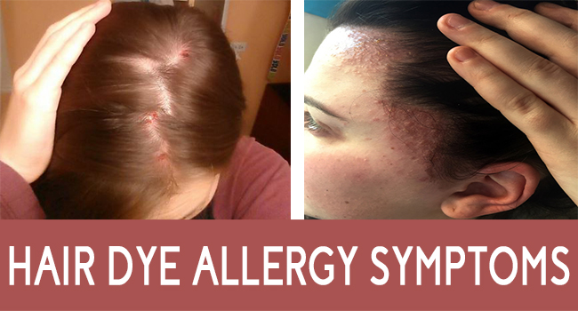 Hair Dye Allergy Symptoms Allergy symptoms