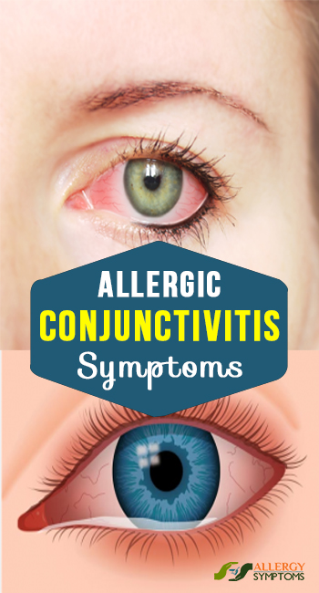 Allergic Conjunctivitis Symptoms