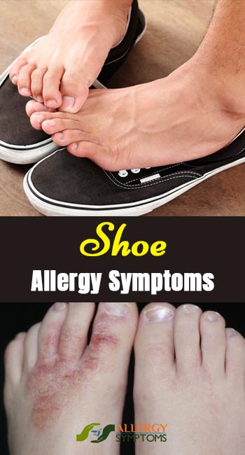 Shoe Allergy Symptoms