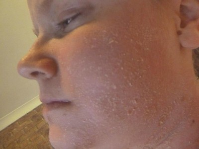 Sunscreen Allergy