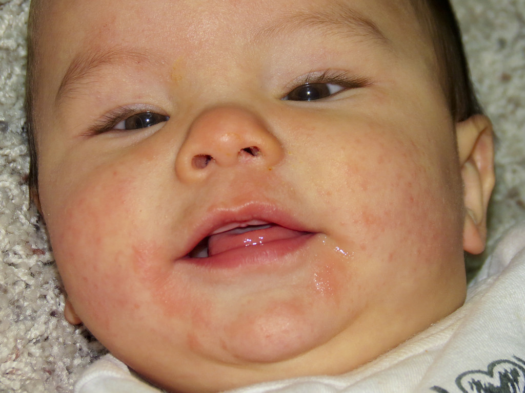 Milk Allergy Baby Rash On Face Treatment