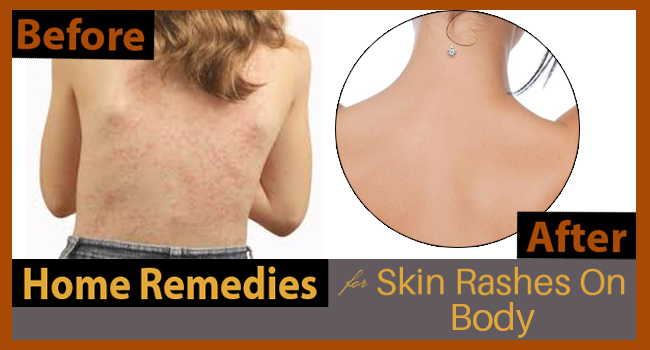 Home Remedies For Skin Rashes On Body Allergy