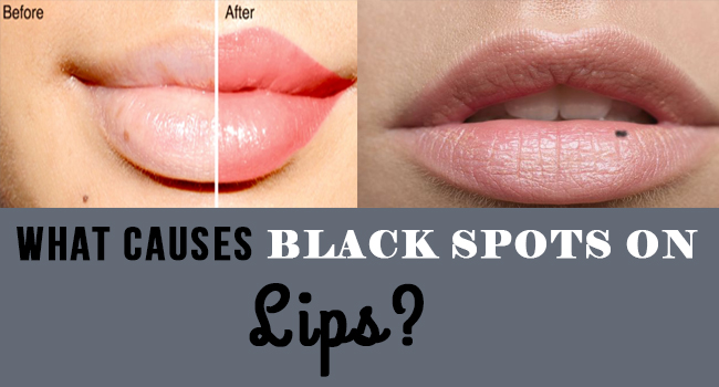 What Causes Black Spots on Lips? - Allergy-symptoms.org