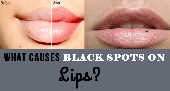 what-causes-black-spots-on-lips-allergy-symptoms