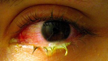 Allergic Conjunctivitis Symptoms