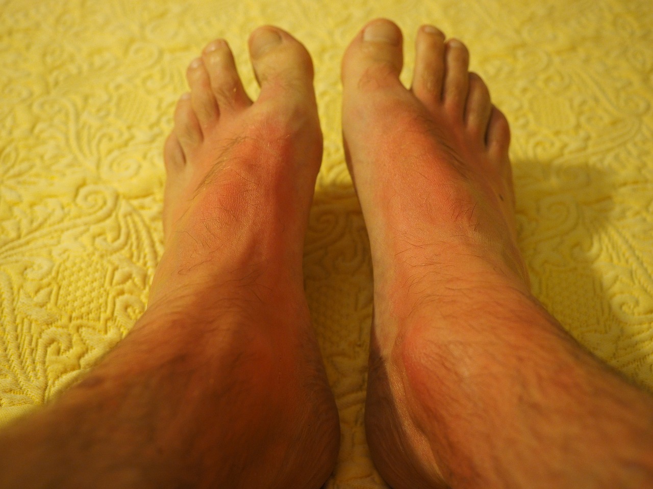 Sunscreen Allergy Symptoms Allergy Symptoms