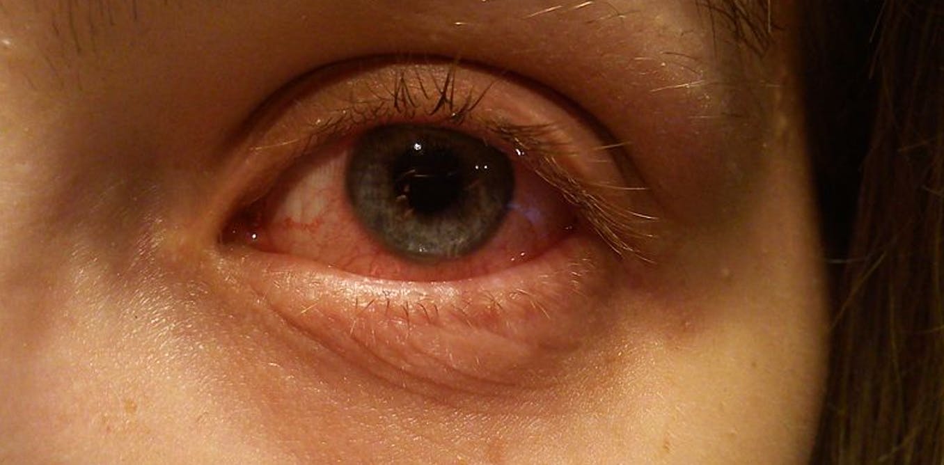 How To Get Rid Of Red Eyes Caused By Allergies