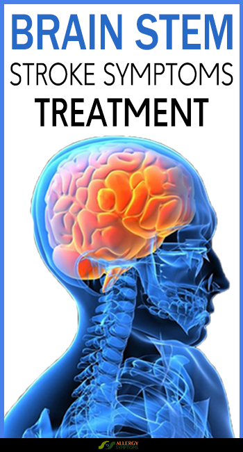 Brain Stem Stroke Symptoms & Treatment