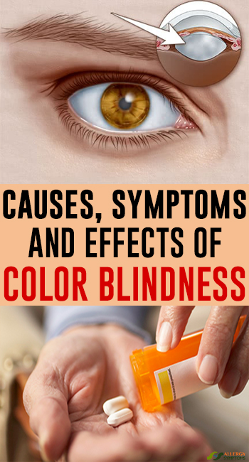 Causes, symptoms and effects of color blindness